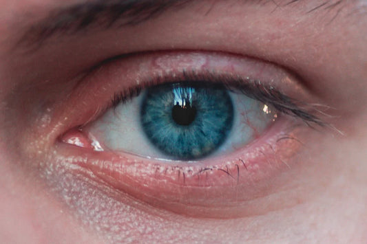 irritation eyelash