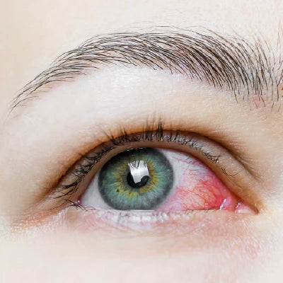 foto mata iritasai saat pemasangan eyelash